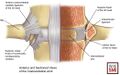 Anterior and sectioned views of the costovertebral joint: the superior costal articular facet or fovea of the vertebral body below articulates with the inferior articular facet of the numerically corresponding rib head.[1]