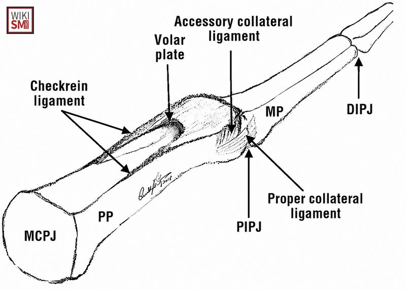 File:Volar plate hand.jpeg