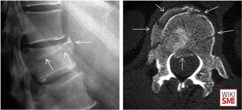 File:Burst fracture XR CT.jpeg