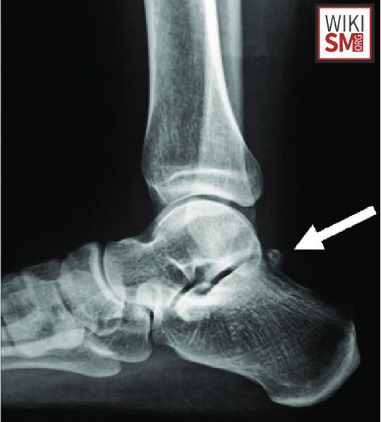File:Hallux saltans os trigonum.jpeg