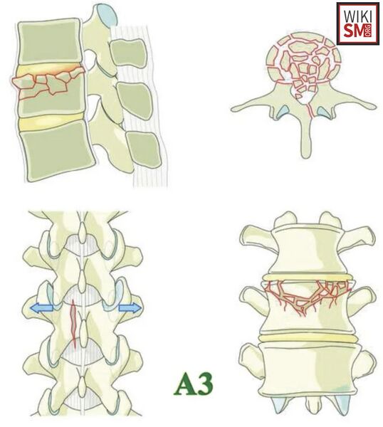 File:Incomplete burst fracture.jpeg