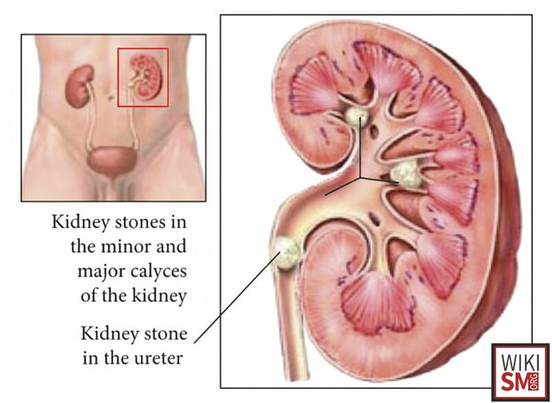 File:Kidney stone illustration.jpeg