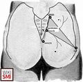 Diagram of the piriformis muscle ’ s surface marking. GT greater trochanter, PSIS posterior superior iliac spine, X point midway between coccyx and PSIS[5]