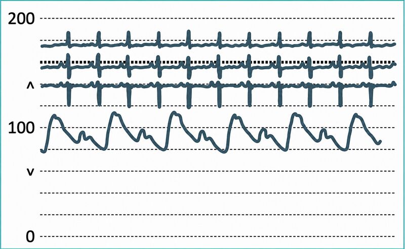 File:Electrical Alternans rhythm strip.jpg