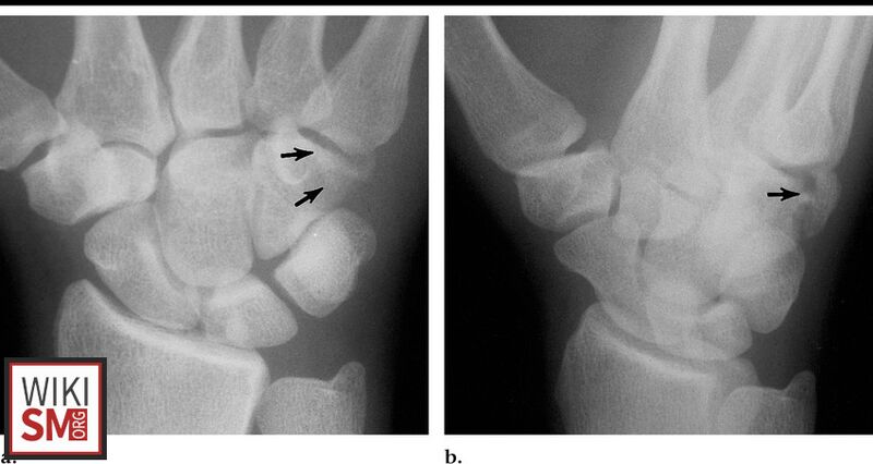 File:Hamate fracture xray.jpeg