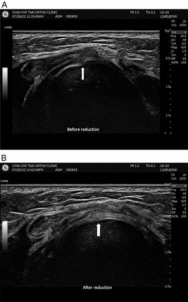File:Nursemaids elbow ultrasound.jpg
