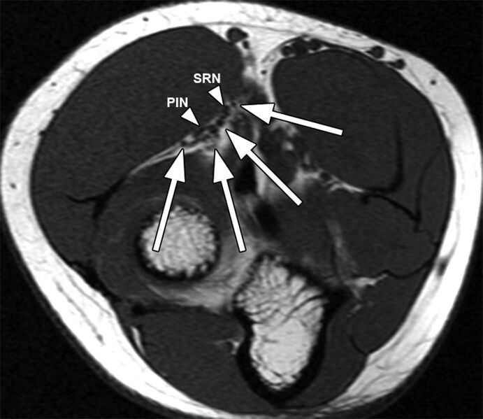 File:Radial tunnel syndrome.jpg