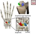 A three-dimensional rendering of the scapholunate interosseous ligament is presented (top right). Removing the scaphoid reveals the dorsal (blue), proximal (yellow), and volar (green) regions of the the interosseous scapholunate ligament.[3]