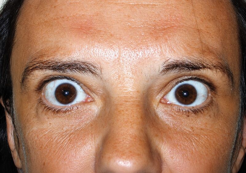 File:Stellwag Sign Graves Disease.jpg