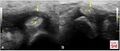 Right (A) and left (B) short-axis images of the flexor carpi radialis tendon (FCR) at the scaphoid at initial presentation. On the symptomatic right side, there is marked thickening of the retinaculum (arrow) compared with the left, consistent with tenosynovitis[1]