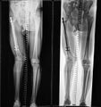 This was a patient presenting with an abnormal gait. The right femur measures approximately 41 cm, while the left femur is about 47 cm, resulting in a limb length discrepancy of roughly 6 cm. Internal fixation with an intramedullary metallic long rod and screws has been applied to the right femur. There is mild right coxa vara and slight internal bowing of the right femur.[5]