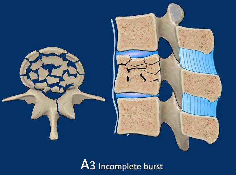File:Incomplete burst fracture illustration.jpg