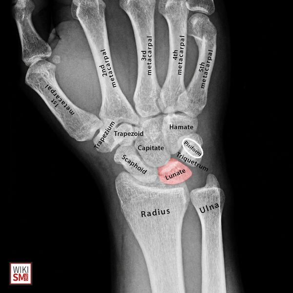 File:Lunate anatomy xray.jpeg