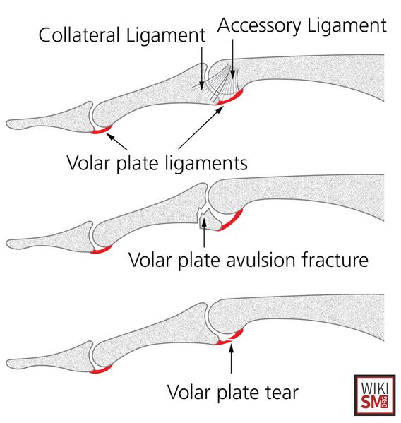 File:Volar plate injuries.jpeg