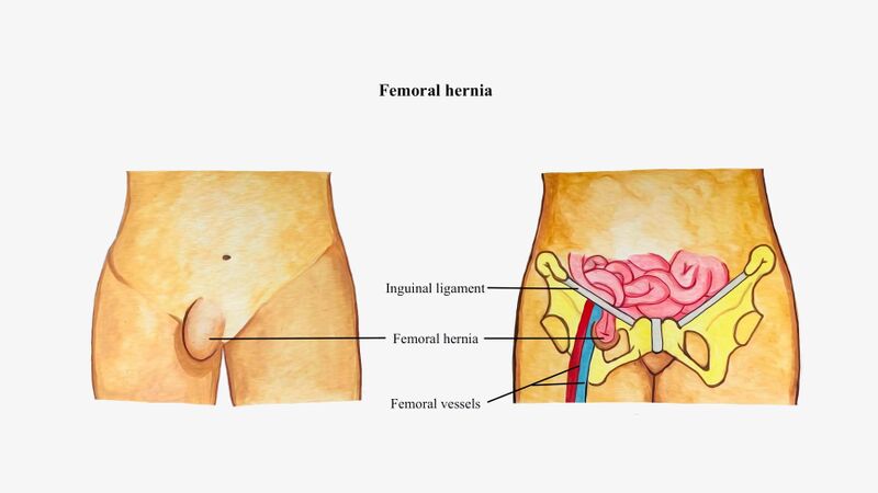 File:Femoral hernia illustration.jpg