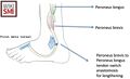 Schematic diagram showing peroneus longus to peroneus brevis tendon switch operation to negate the peroneus recruitment.[3]